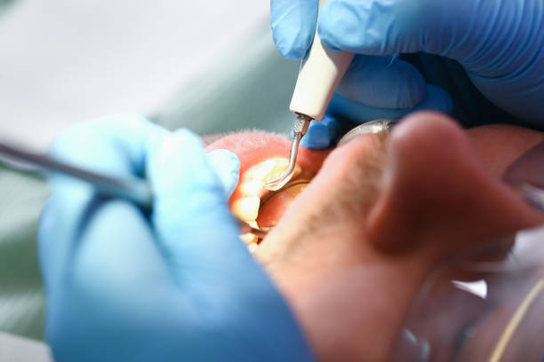 Best Broken or Chipped Tooth Repair in Sargent, TX